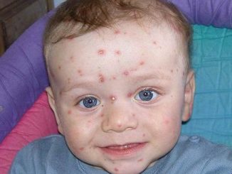 Un enfant atteint de la maladie de la varicelle