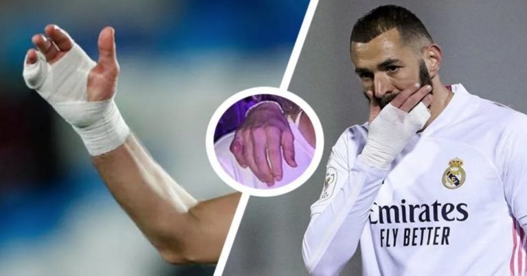 Euro-2021 : Pourquoi Karim Benzema porte-t-il un bandage à la main pendant deux ans ?