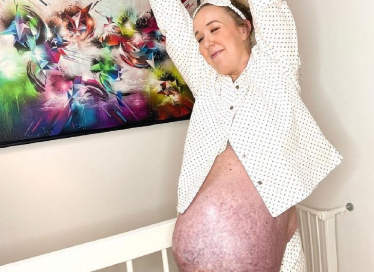 Le ventre surprenant d'une femme qui a donné naissance à des triplés